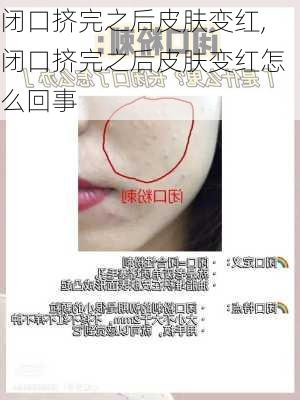 闭口挤完之后皮肤变红,闭口挤完之后皮肤变红怎么回事